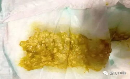 产检发现胎儿在妈妈腹中拉肚子