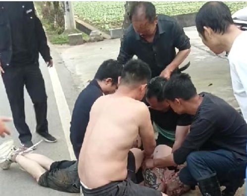 被歹徒咬掉鼻子老人缝了115针 被歹徒咬掉鼻子老人缝了115针